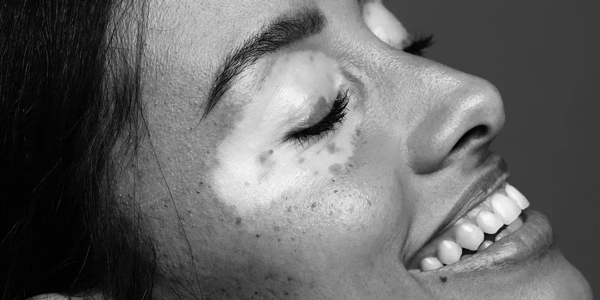 Combination Therapy Offers Hope for Vitiligo Patients