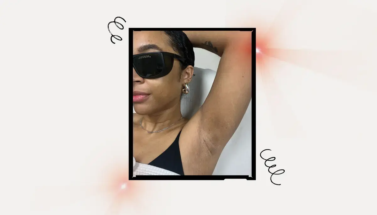 How to Avoid Dark Spots When Using Laser Hair Removal on Darker Skin