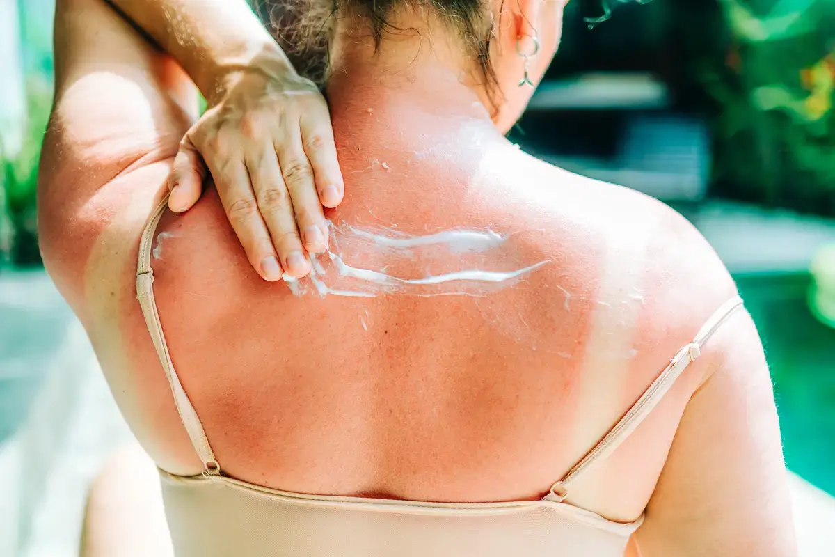 Natural Sunburn Cures for Quick Relief