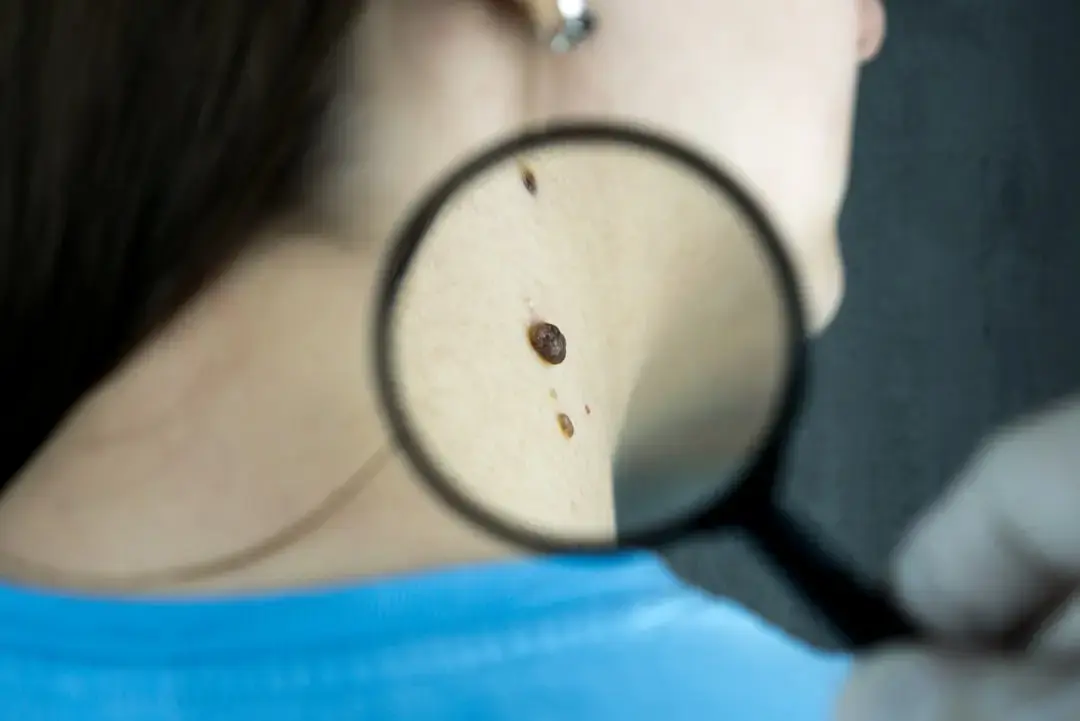 Skin Cancer Self-Diagnosis by a Dermatologist