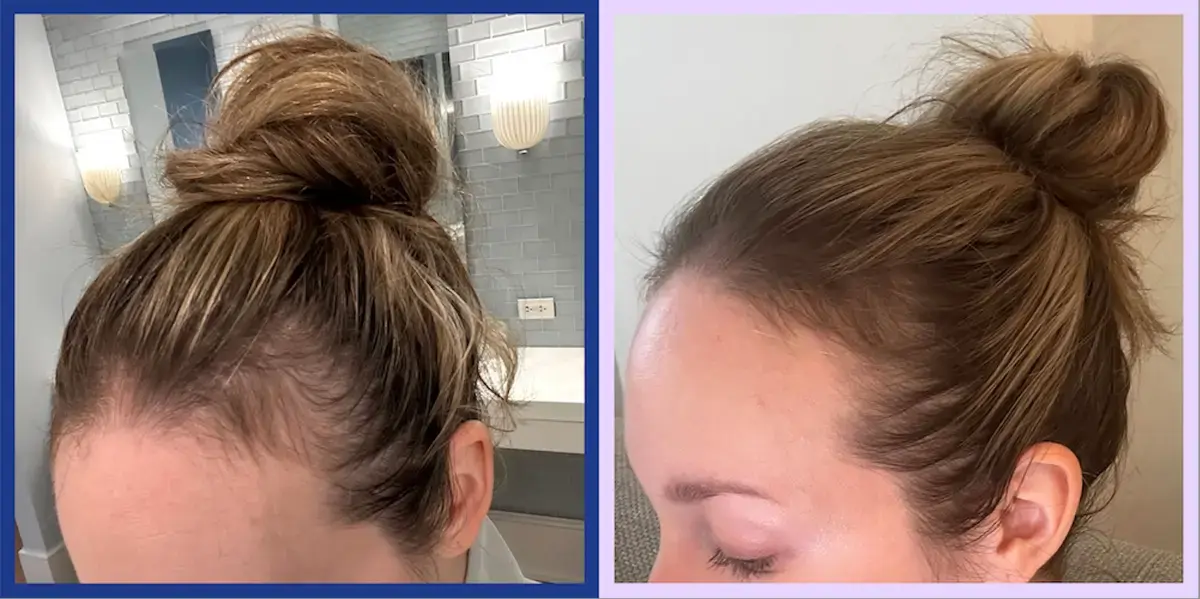 The Top Supplements for Promoting Hair Growth, According to Experts