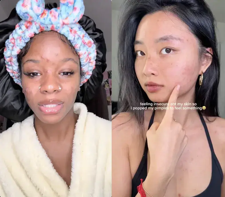 Viral Acne Sensations Lose Their Pimples