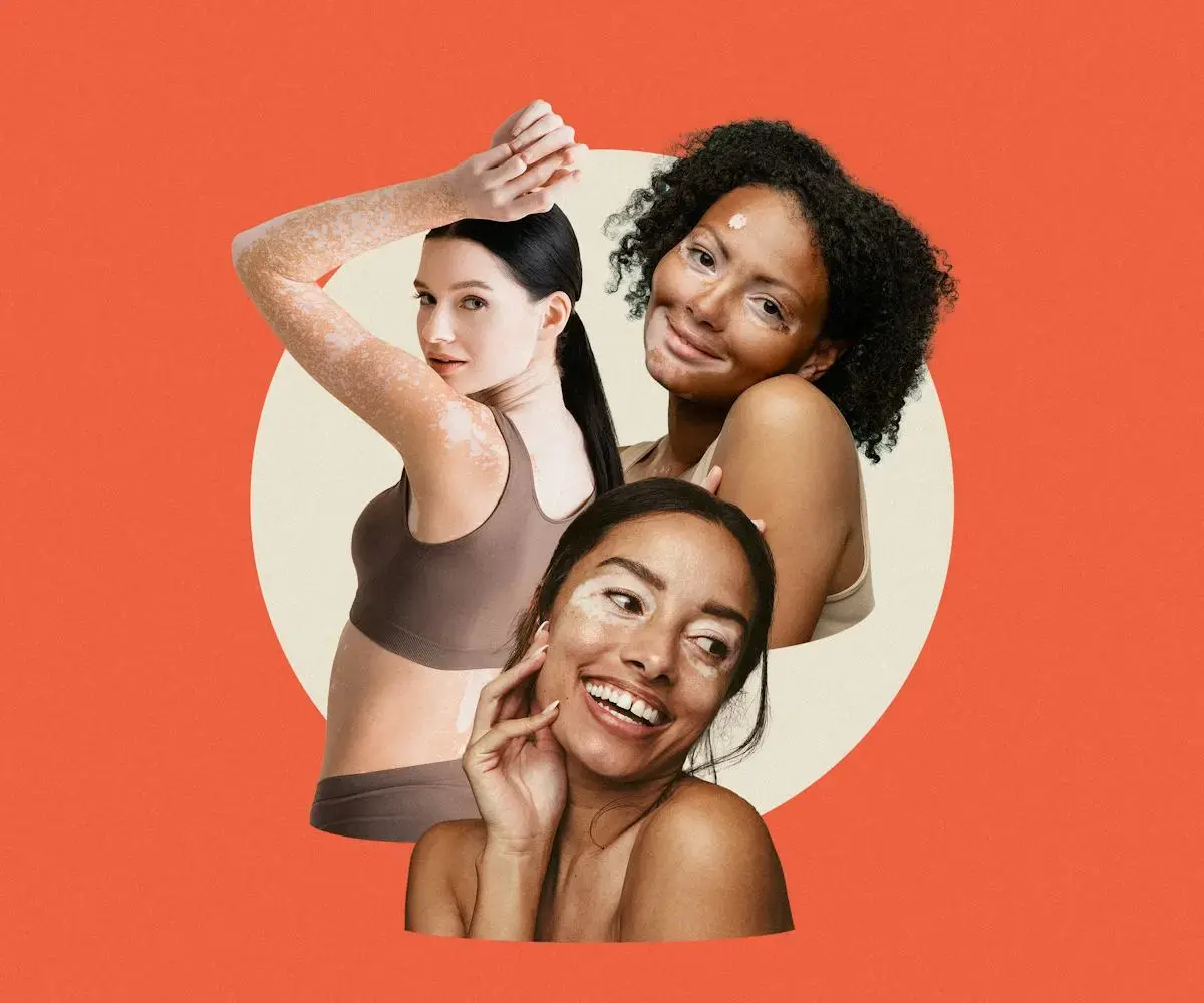 Vitiligo: Beyond the Surface