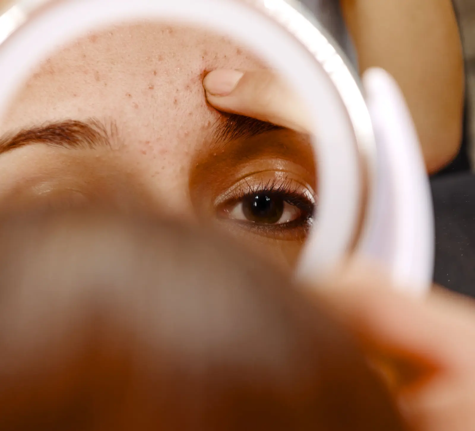 It's Not a Whitehead, It's Milia—Here's How to Treat It